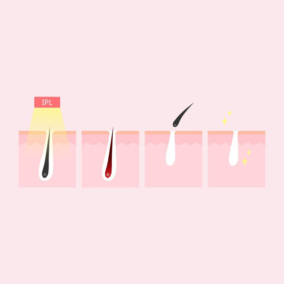 Silhouette Portable Laser Hair Remover Permanent Epliation System Body Face Home - RnR Galore